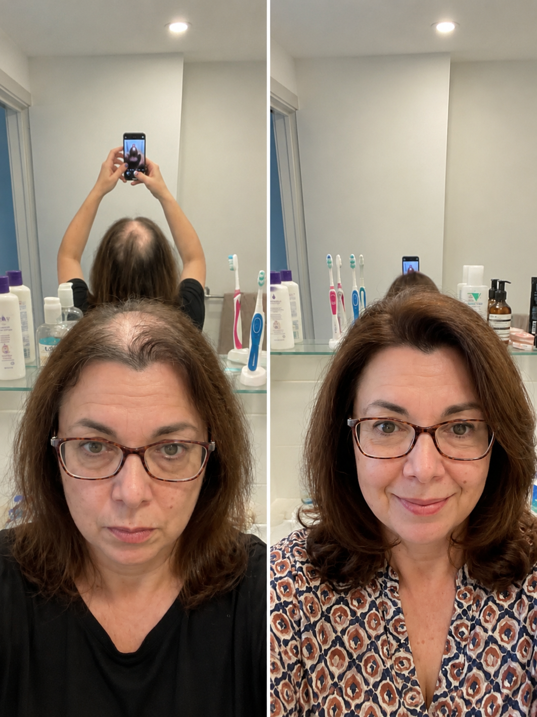 ¡Adiós a la pérdida de cabello, hola a mi nueva melena!